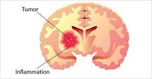 Brain Tumour - Types, Causes, Risks, Symptoms, Prevention Tips