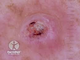 Keratoacanthoma nonpolarised dermoscopy view image