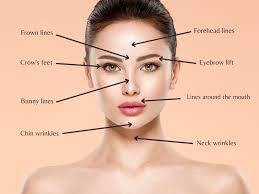 The most common cosmetic botox injection sites are between the eyebrows (to treat frown lines), at the corner of the eyes (to correct crow's feet), forehead creases and wrinkles around the lips. Common Botox Areas For Anti Wrinkle Treatment With Examples