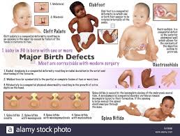 Baby Abnormalities High Resolution Stock Photography And Images Alamy