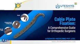 Cable Plate Fixation: A Comprehensive Guide for Orthopedic ...
