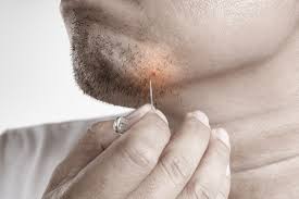Genital warts, also called condyloma accuminata or venereal warts, are symptoms of a highly contagious sexually transmitted disease caused by certain types of human papilloma virus (hpv). Ingrown Hair Causes And Treatment Skin Hair Problems Medical Answers Body Health Conditions Center Steadyhealth Com