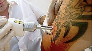 Lasern Und Die Risiken Geht Der Trend Zur Tattoo Entfernung Wissen Stuttgarter Nachrichten