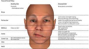 We did not find results for: Jama Internal Medicine On Twitter Angelina Jolie Told Vanityfair She Developed Bell S Palsy Read Our Clinical Evidence Synopsis About Early Treatment Https T Co Fzsqg0qfjv Https T Co W2wj7bhtxj