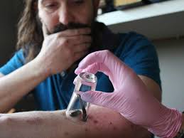 What is bloodletting, and why was it a popular therapy?