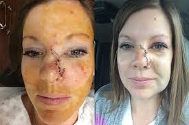 If you have skin cancer, it is important to know which type you have because it affects your treatment options and your outlook (prognosis). Skin Cancer Update Suncare Mel S Kitchen Cafe