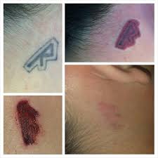 San diego laser removal clinic (sdlr) started in partnership with propaganda tattoo in 2010. Permanent Makeup Tattoo Removal Saubhaya Makeup