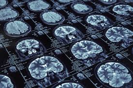 Aducanumab (biib037) is a human antibody that selectively targets aggregated forms of aβ, including soluble oligomers and insoluble fibrils. Biogen Shares Pop As It Completes Filing For Alzheimer S Drug Aducanumab