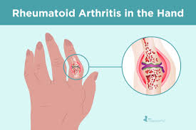Rheumatoid arthritis is an autoimmune disease that occurs when the body's immune system attacks the joint linings (synovium) that produce fluid that lubricates the joints. Rheumatoid Arthritis In The Hands Symptoms And Treatments
