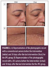 Plasma Jet versus Electrocarbonization in the Treatment of Wrinkles of the  Upper Palpebral Region