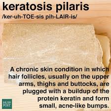 However, if you have a history of infections, trauma or breakouts, there may be an underlying cause for the problems. What Is Keratosis Pilaris And Why Does It Look Like Body Acne Huffpost Life