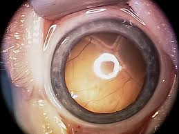 Image result for Intraocular Pressure