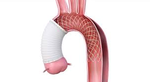 Image result for Aortic Dissection