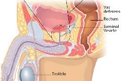 Prostate cancer is one of the most common types of cancer diagnosed in men. Basic Information About Prostate Cancer Cdc