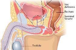 Other than skin cancer, prostate cancer is the most common cancer in american men. Basic Information About Prostate Cancer Cdc