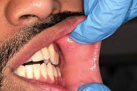 Cancer of the mouth and throat includes the lips, cheeks, neck, and tongue. Reconstructive Surgery For Mouth Cancer In Varanasi India Oral Reconstructive Surgery
