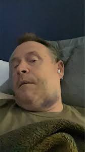 Heat or ice for facial swelling after surgery?