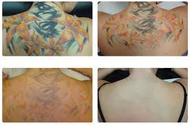It's important to note that different colors of ink require different wavelengths. An Idiot S Guide To Laser Tattoo Removal Dr Nathan Holt