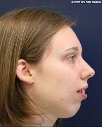 Convex Profile Receding Forehead And Chin It Calls For An Arrangement Of Curls Or Bangs Over The Forehead Keep The S Face Profile Female Profile Face Shapes