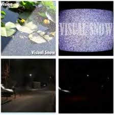 Visual snow syndrome is a neurological condition. Presistant Visual Noise Visual Snow Syndrome