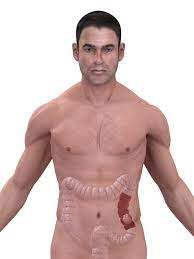 Could you pull a muscle in your lower abdomen? Left Lower Abdomen