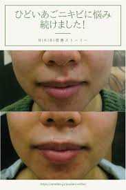 ひどいあごニキビに悩み続けました お客様体験談vol 33 2021 ニキビ 皮膚科 顎