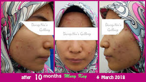 Welcome to the official mary kay page. Diary Nie S Gallery Jerawat Makin Banyak Pakai Mary Kay