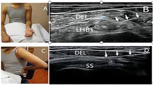 Image result for Biceps Tendon Injection