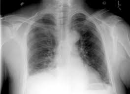 Patients will not always be symptomatic and treatment will depend on the cause. Trick Of The Trade Finding The Subtle Pneumothorax