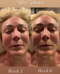 Sculpting Buccal Massages! Profile photos are of her before receiving any  massage and before her last 6th session. Face forward photos are of her  after her 1st session and after her 6th