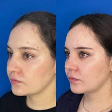 El botox siempre es nuestro...