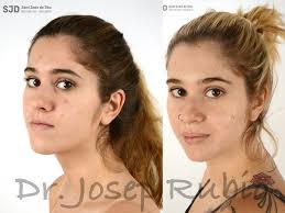 Compartimos el caso de María tratada mediante cirugía ortognática bimaxilar  para corregir una deformidad dentofacial clase III esquelética por  hipoplasia maxilar y asimetría mandibular. 📝 El plan de tratamiento fue: