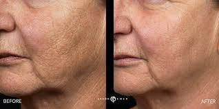 Fraxel® lasers are more effective for acne scars, including rolling, boxcar, and icepick scars, than any topical treatment currently available. Fraxel Laser Skin Resurfacing Jason Emer Md