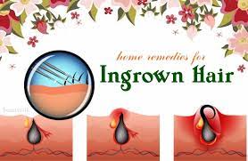 The ingrown hair takes care of itself but if it doesn't there are a few home remedies in this article that can help you get rid of them. Herbal Remedy For Ingrown Hair Ingrown Hair