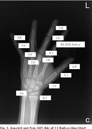 Figure 3 From Maturation Disparity Between Hand Wrist Bones