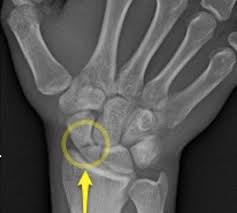 Image result for Scaphoid Fracture Signs