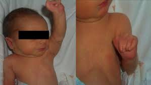 How evident poland syndrome may be in a newborn child will depend very much on the severity of a baby displaying hand malformations as a feature of their poland syndrome will often receive some. A Case Of Poland Syndrome Associated With Dextroposition Italian Journal Of Pediatrics Full Text