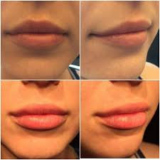 Pin On Juvederm Juvederm Voluma