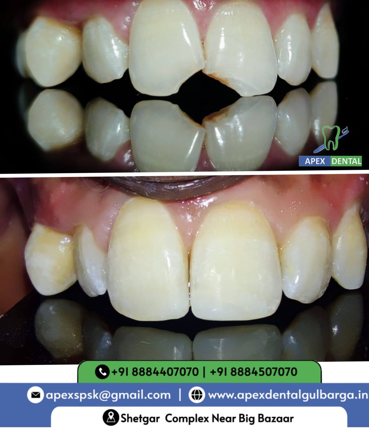 Dental composite restoration product image