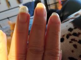 I am curious if this is a known condition, as i would like to learn more about it, but do not know its name to for me, it has occurred only on one or two fingers during the last year. Peeling Skin Below Finger Nails What Could Be The Problem Quora