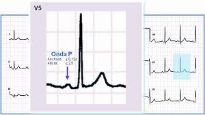An electrocardiogram (ekg) to record your heart's electrical activity; De Las Ondas Del Ecg A La Patologia A Que Puede Corresponder Cada Alteracion De Una Onda Complejo O Intervalo Amf 2012