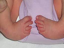 It's a birth defect that makes one or both of a baby's feet point down and turn in. Clubfoot Wikipedia