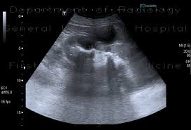 Image result for Nephrolithiasis Imaging