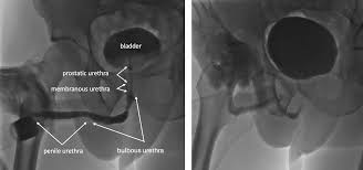 Image result for Voiding Cystourethrogram