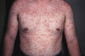 Kasus sifilis menurun hingga tahun 2000, namun. Wow 30 Gambar Kartun Penyakit Sifilis Kumpulan Gambar Kartun