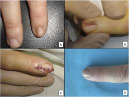 Image result for Acral lentiginous melanoma nail