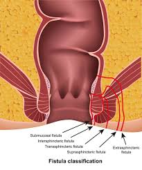 Image result for Ischiorectal Abscess