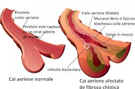Dr ditoiu alecse valerian spitalul fundeni clinica medicala. Fibroza Chistica Mucoviscidoza