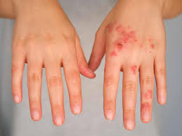 Image result for Impetigo
