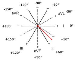 Umfang kreis einfach erklärt aufgaben mit lösungen zusammenfassung als pdf jetzt kostenlos dieses thema lernen! Qrs Achse Und Ekg Lagetypen Fokus Ekg